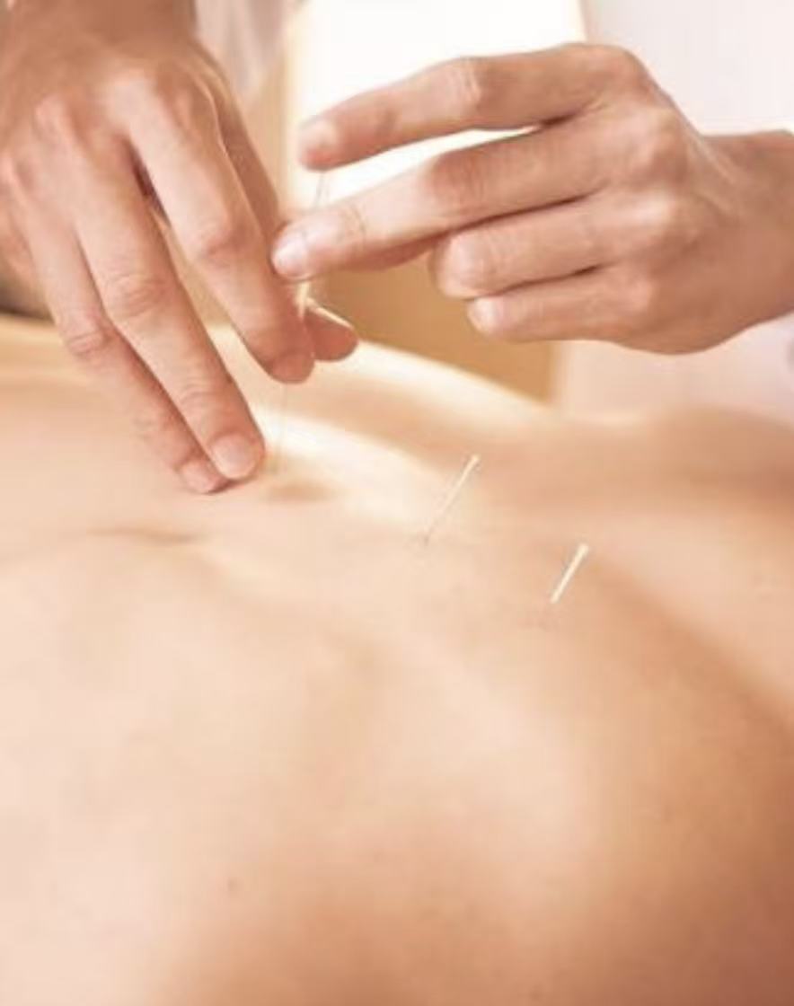 Séance d'acupuncture